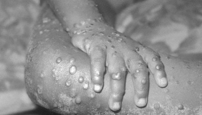 Monkeypox is spreading in India too, this time symptoms appeared in an 8-year-old child in Andhra Pradesh!